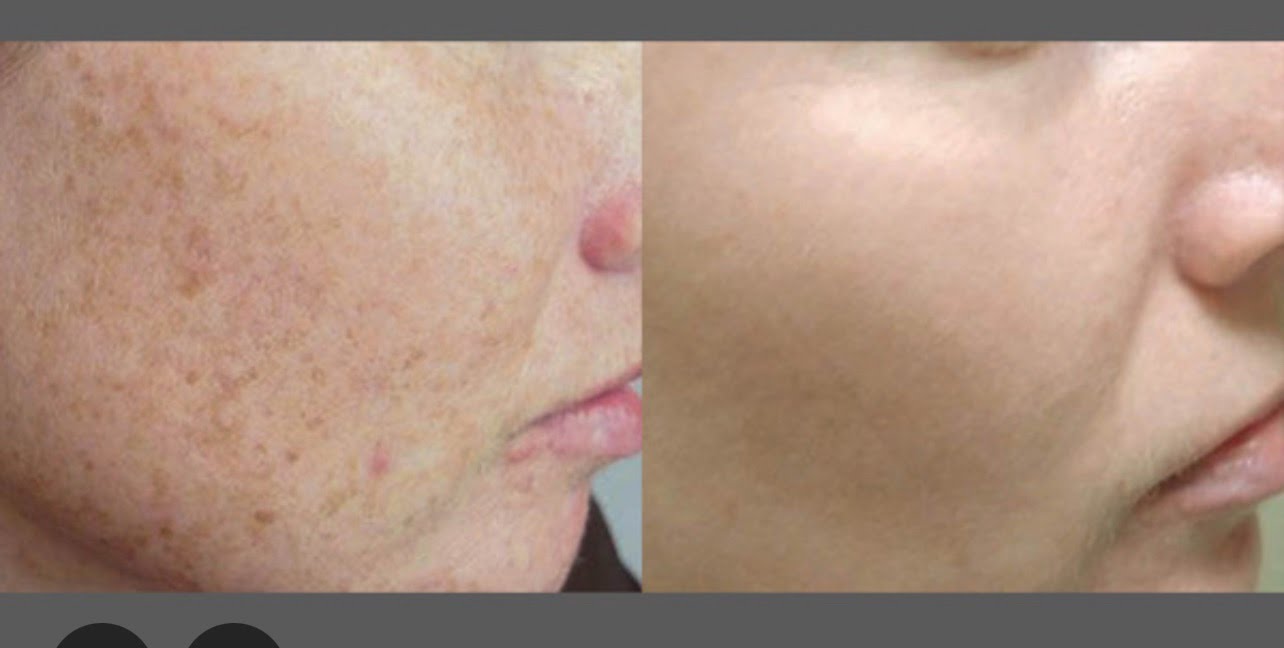 IPL laser treatment