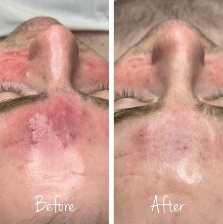 Acne Peel Grades III-IV